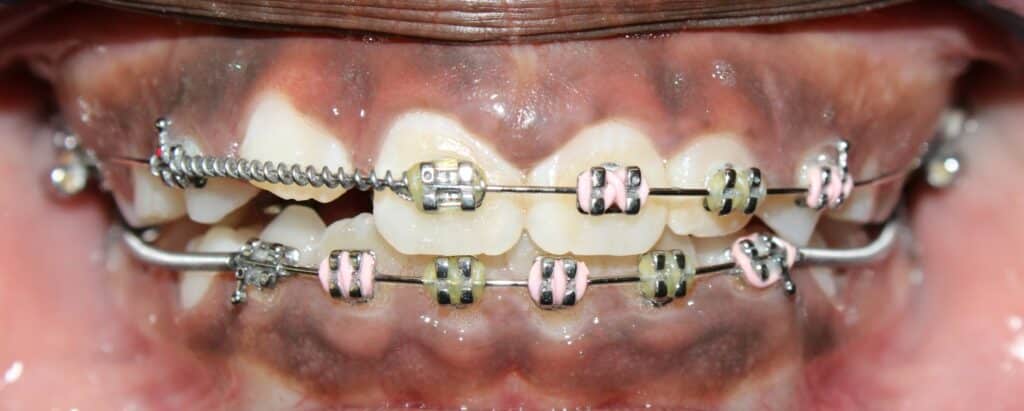 orthodontic closure of an anterior open bite with tongue crib habit appliance and braces in phase 1 treatment;  child patient smiling with traditional metal braces in Glendale orthodontic office
