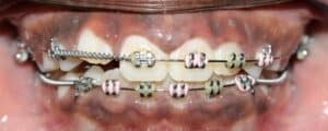 orthodontic closure of an anterior open bite with tongue crib habit appliance and braces in phase 1 treatment