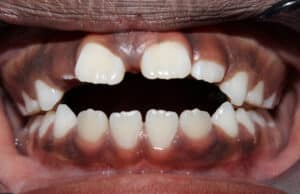 anterior open bite, tongue thrust habit, orthodontics