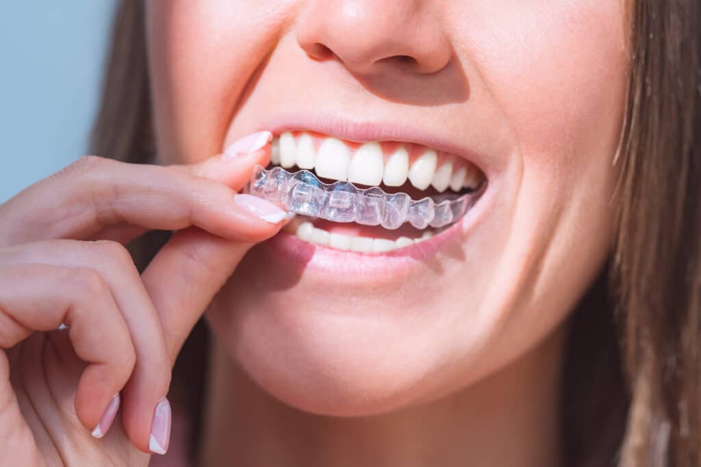 Close-up of a person inserting an Invisalign, showcasing the comfort and invisibility of Invisalign treatment in Glendale, CA.