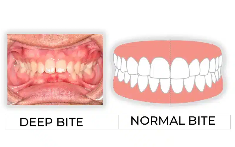 deep bite and normal bite