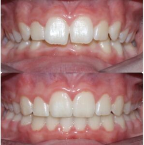 deep bite before and after treatment